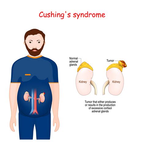 cushing syndrome adalah